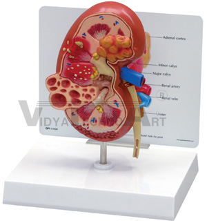 Diseased Kidney